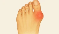 Halluks valgus estetik bir sorundan çok daha fazlası!