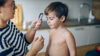 Suçiçeği vakaları artıyor