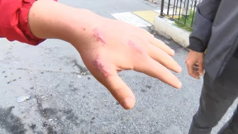 Esenyurt'ta evcil bir kedi sahibinin parmağını ısırarak kopardı