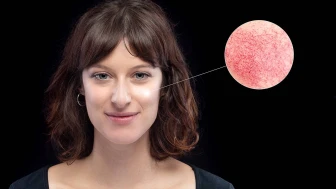 Kızarıklık hastalık belirtisi