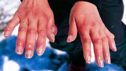 Soğuk hava ısırmasın!