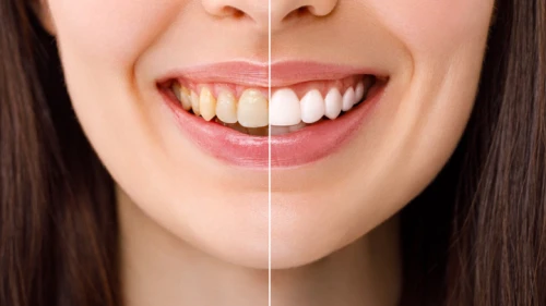 Diş beyazlatırken dikkat!